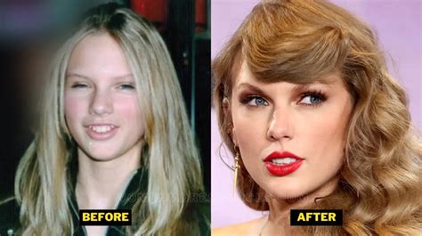 did taylor swift get her teeth fixed